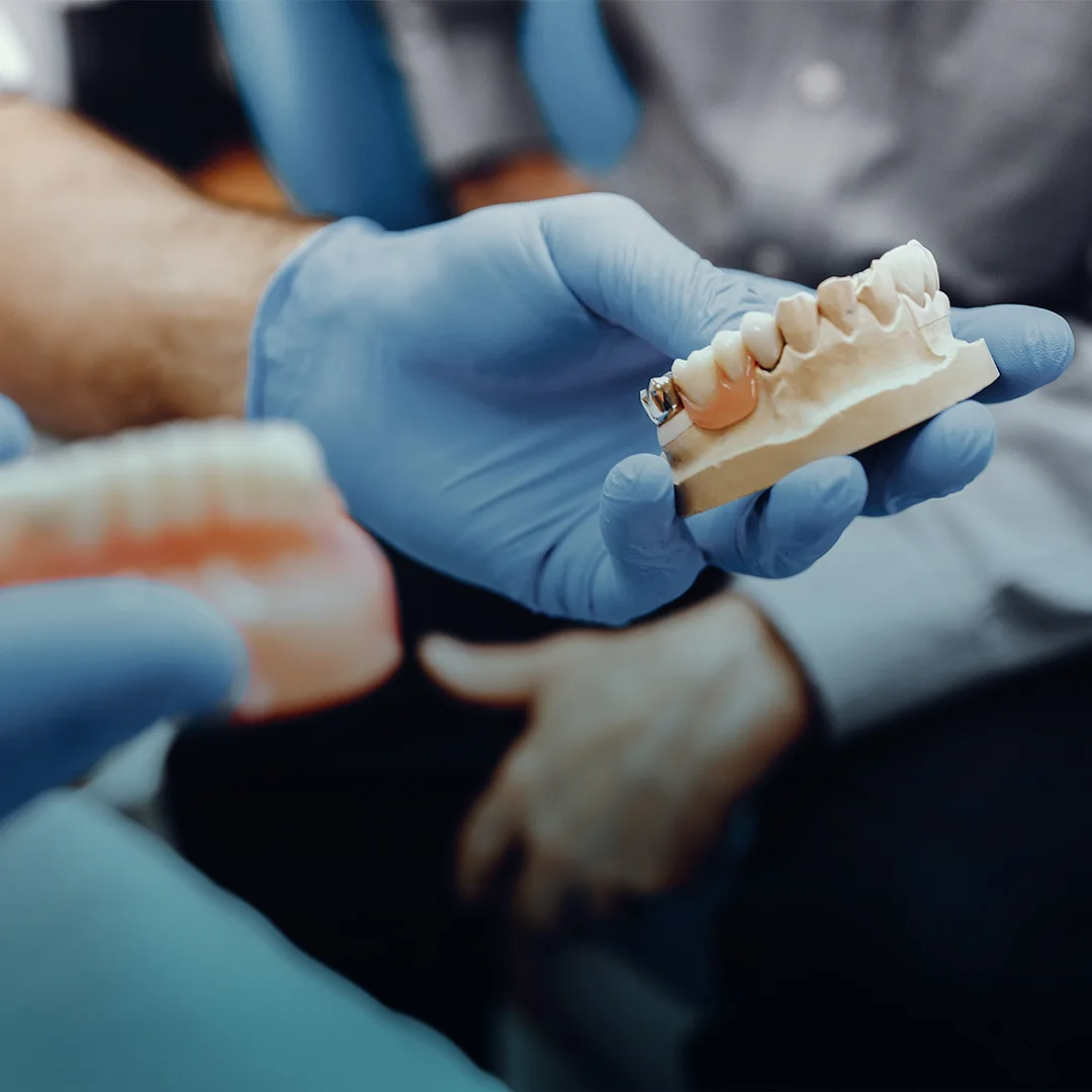 Dental implants treatment at Smile Design Team