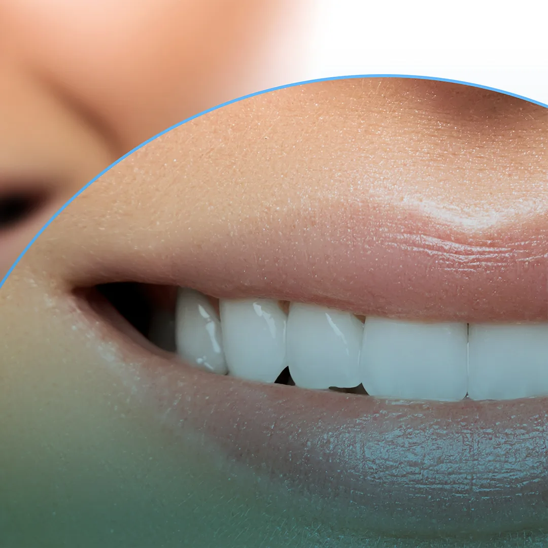 Porcelain veneers at Smile Design Team