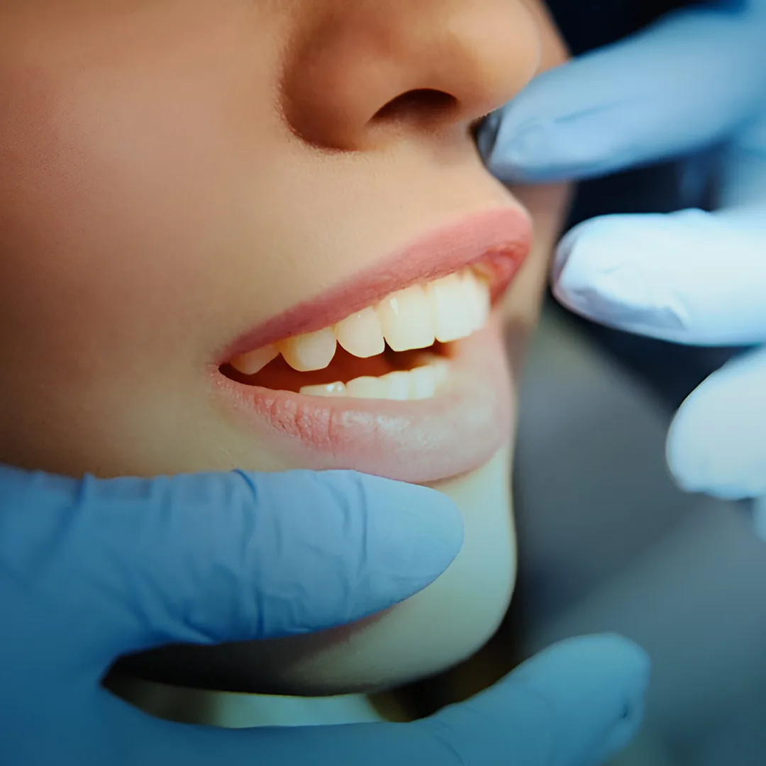Tooth colored fillings at Smile Design Team