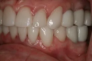After photo of a veneers and dental implants smile makeover case