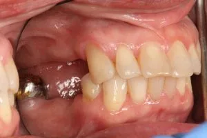 Before photo of a veneers and implants cosmetic dentistry case