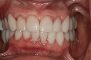 After photo of a Smile Design Dental Team veneers and implants case