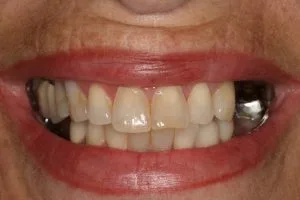 Before photo of a full smile restoration using veneers and implants
