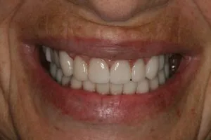 After photo of a full smile restoration using veneers and implants