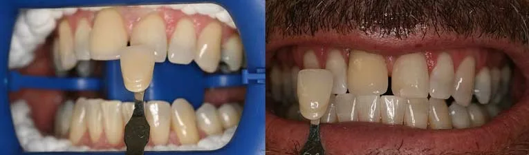 Zoom teeth whitening at Smile Design Team